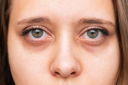 Symptome von dunklen Augenringen