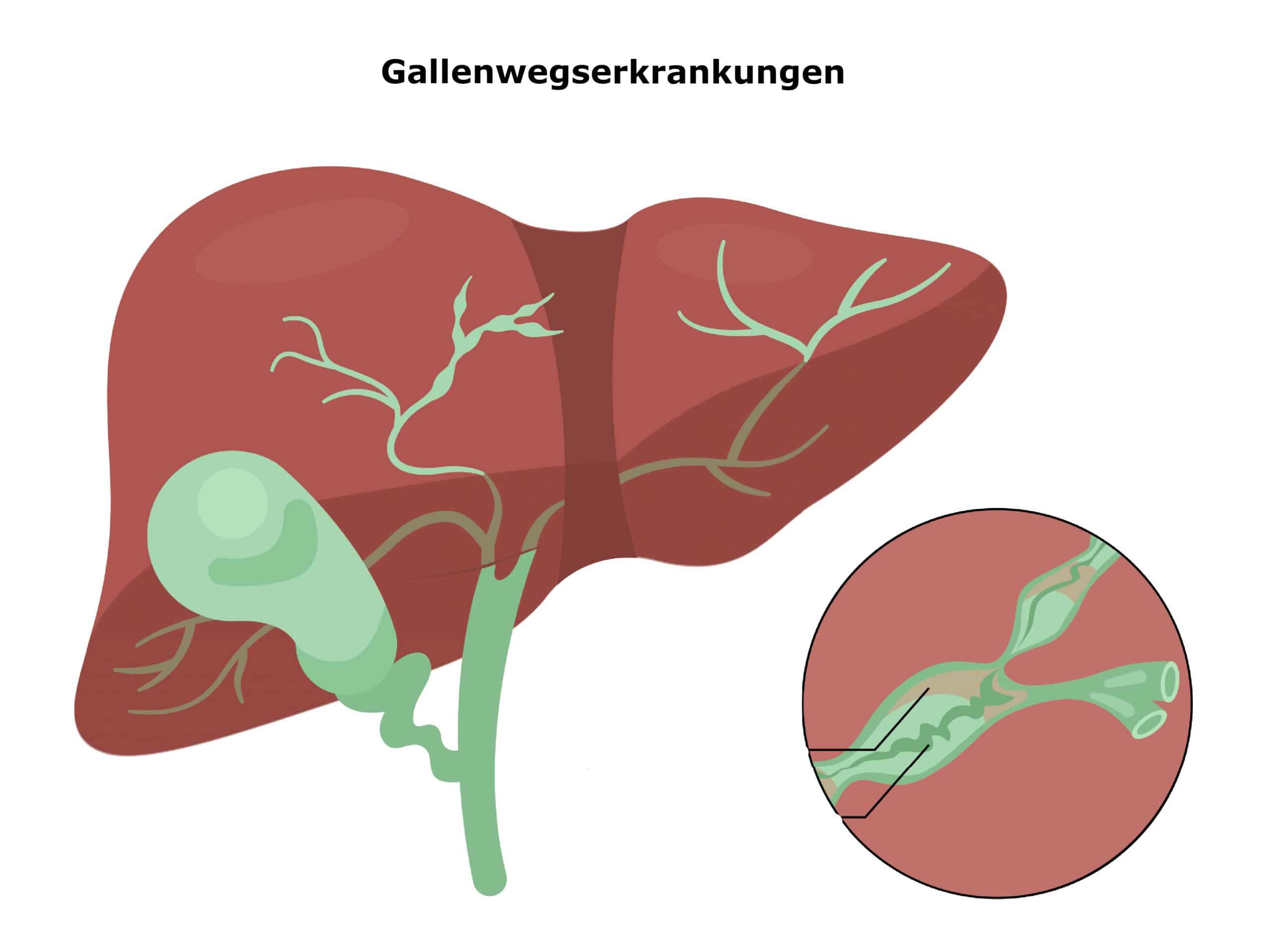 Gallenwegserkrankungen